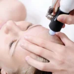 Can Microdermabrasion Help Eczema?