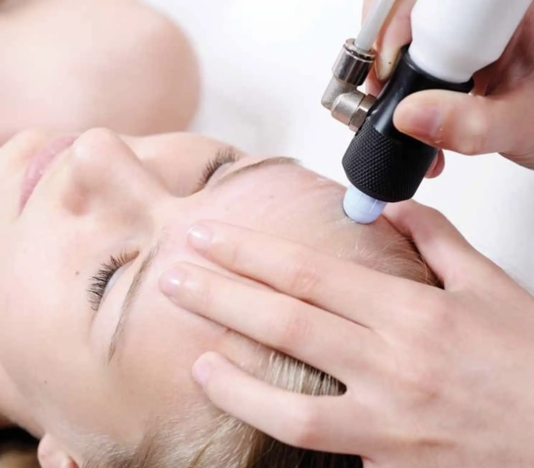 is microdermabrasion safe for eczema