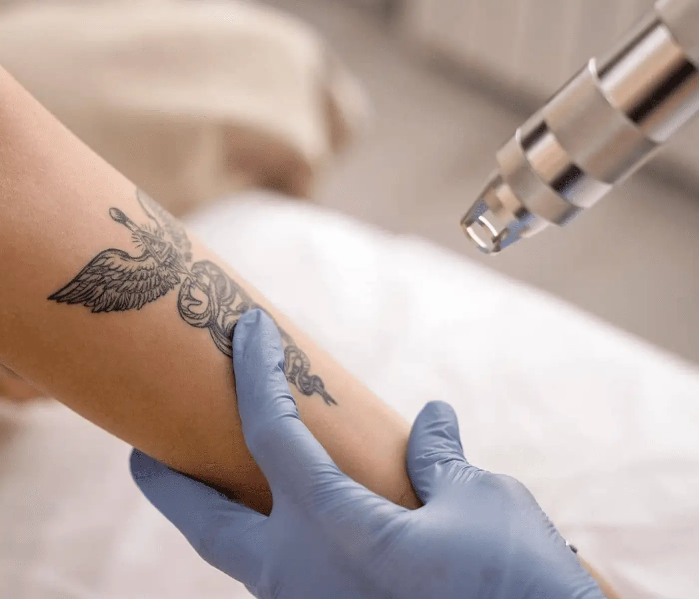 laser tattoo removal